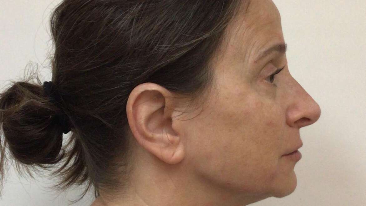 Dermal Fillers Treatment – Female (58 years old)