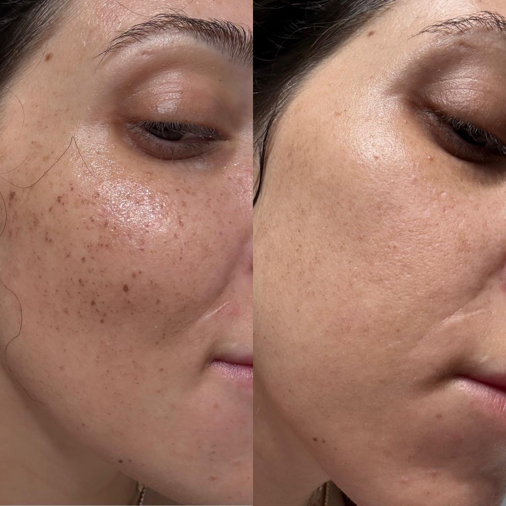 Before & After IPL treatments to the face to lighten hyperpigmentation