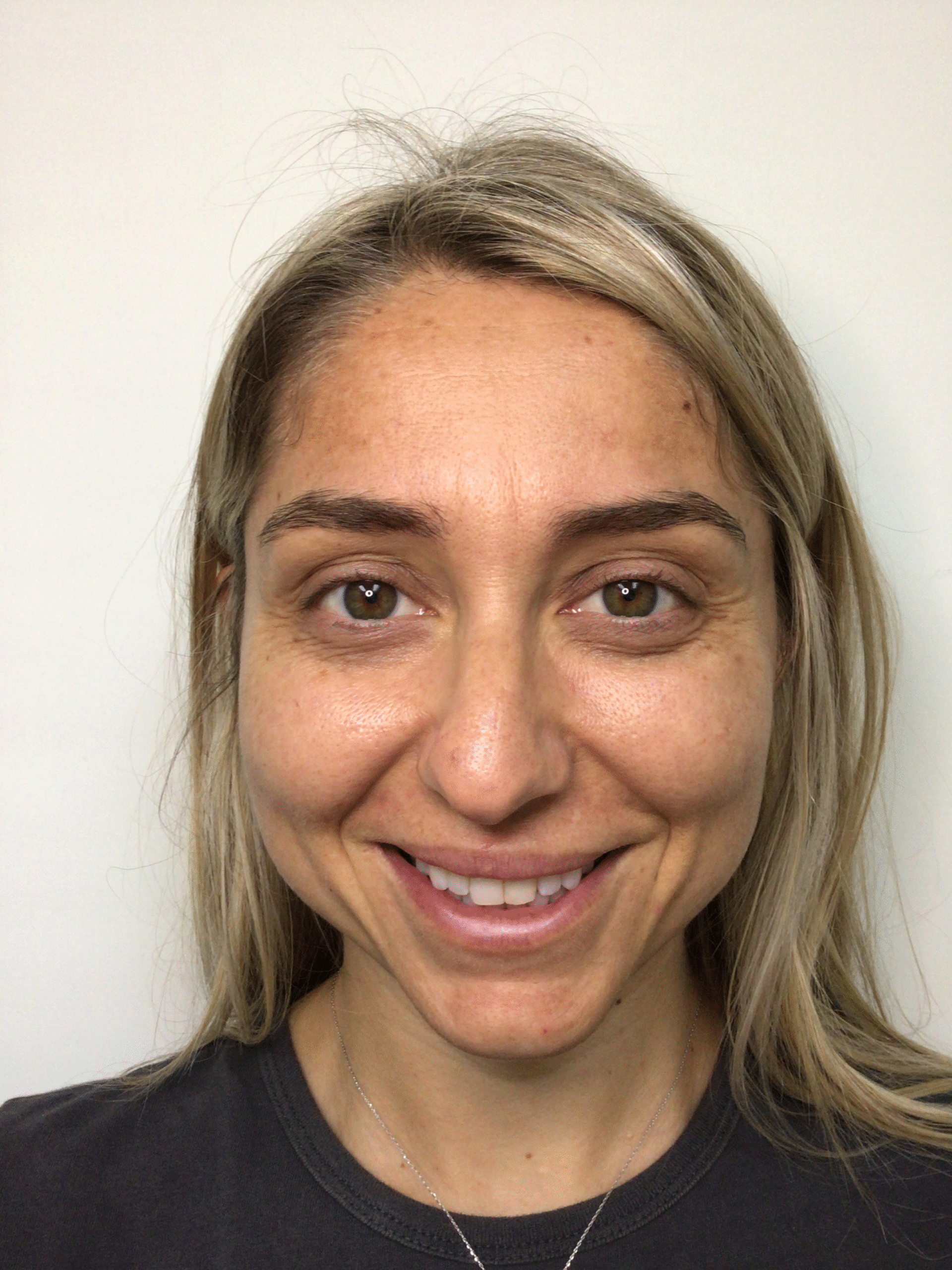 Before Procedure