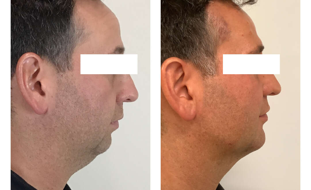 Juvederm Voluma & Volux for Chin, Cheeks & Jawline – 45-Year-Old Patient
