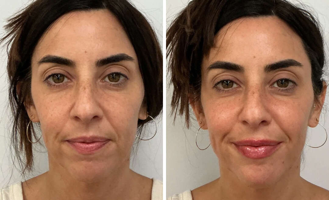Juvederm Voluma, Volux & Volbella – Cheeks, Jawline & Lips, 36-Year-Old