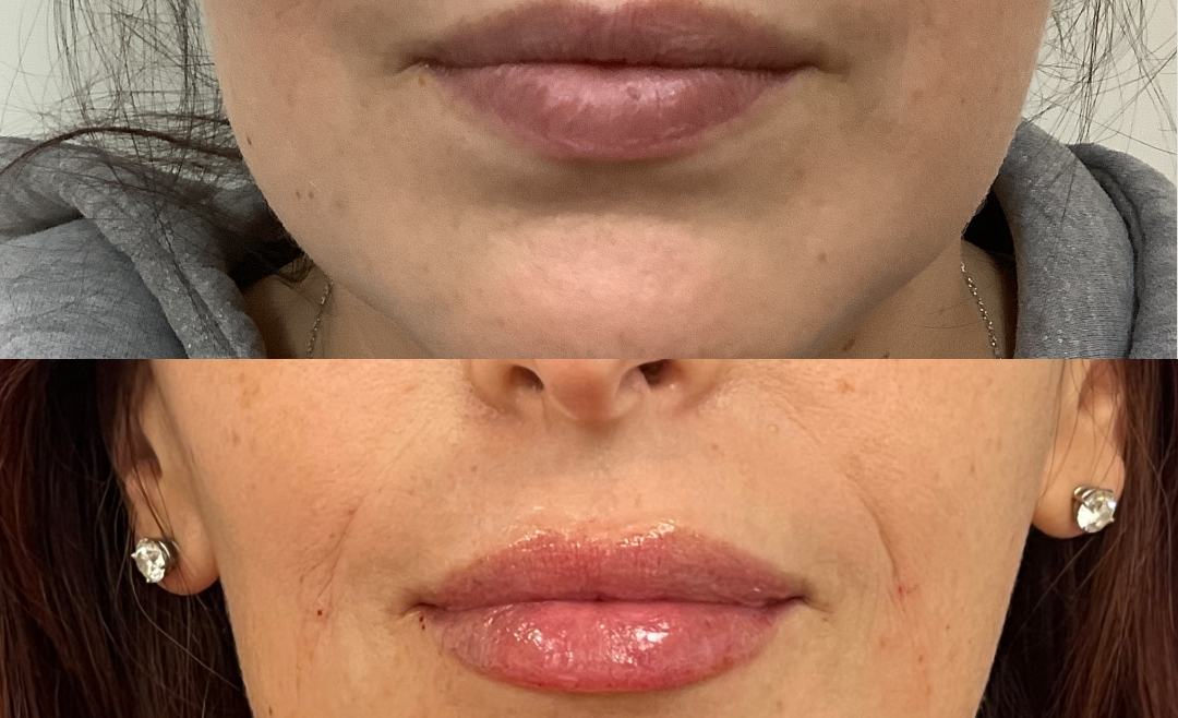 Juvederm Volbella for Lips, 36-Year-Old