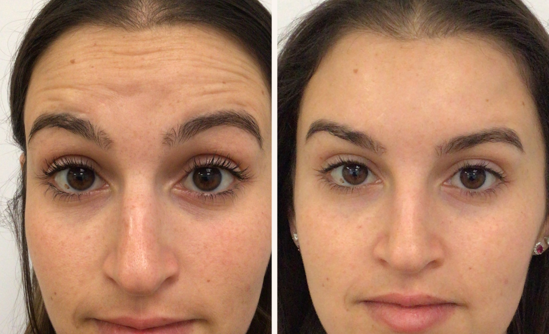 31-Year-Old Patient Receives Botox to Smooth Frown, Forehead & Smile Lines