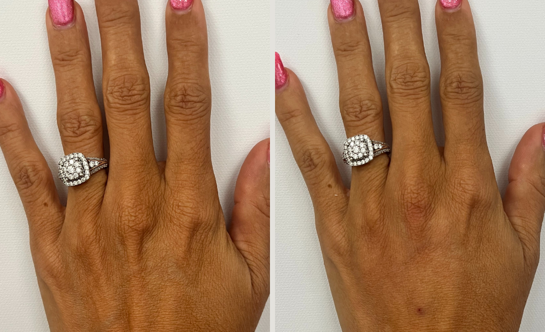 Renuva Injectable Treatment to Restore Hand Volume – (53 Years Old)