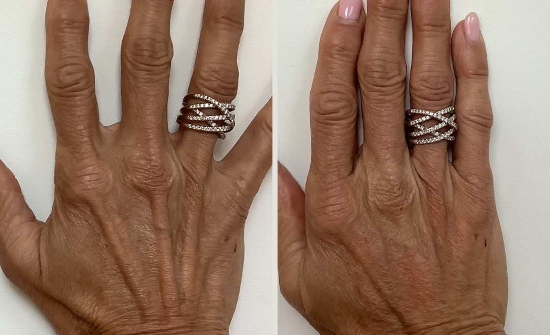 Renuva Injectable Treatment to Restore Hand Volume – (62 Years Old)