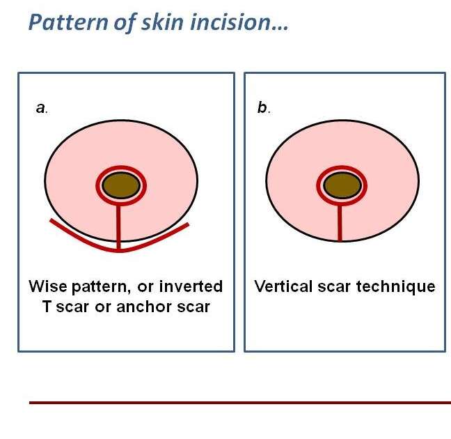 breast lift incision scars