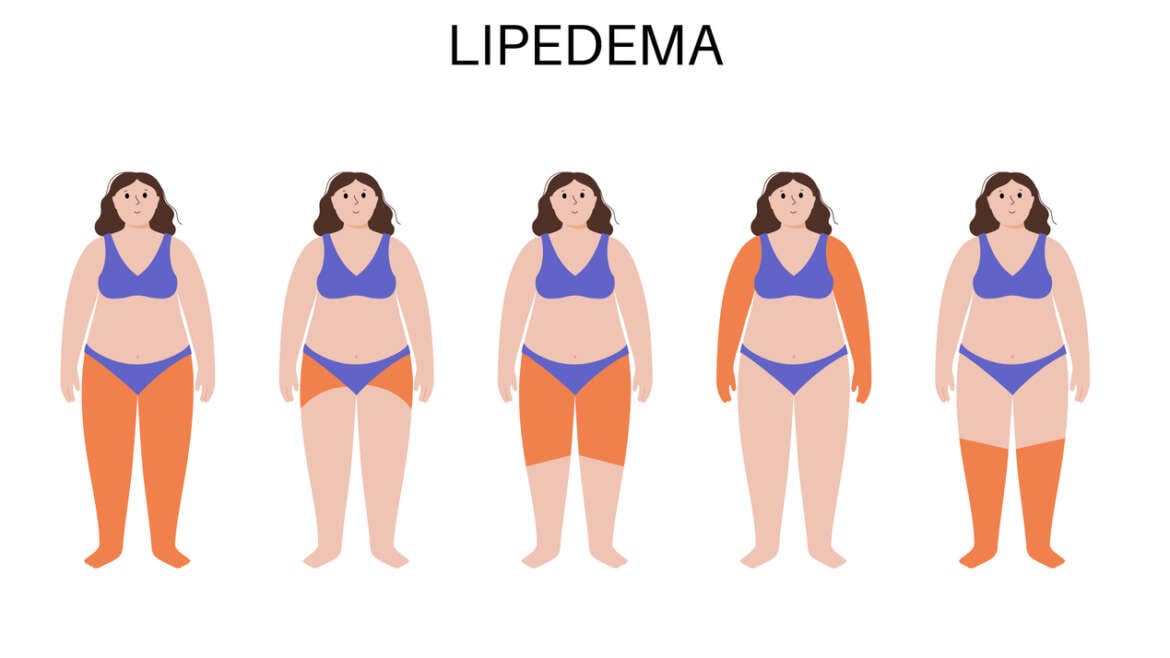 Maximizing Lipedema Results: How Exilis® and Sofwave™ Enhance Tumescent Liposuction