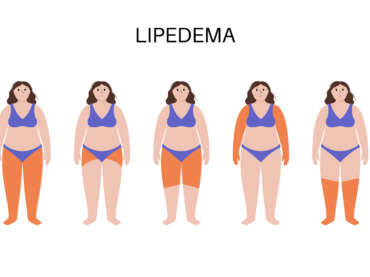 Maximizing Lipedema Results: How Exilis® and Sofwave™ Enhance Tumescent Liposuction