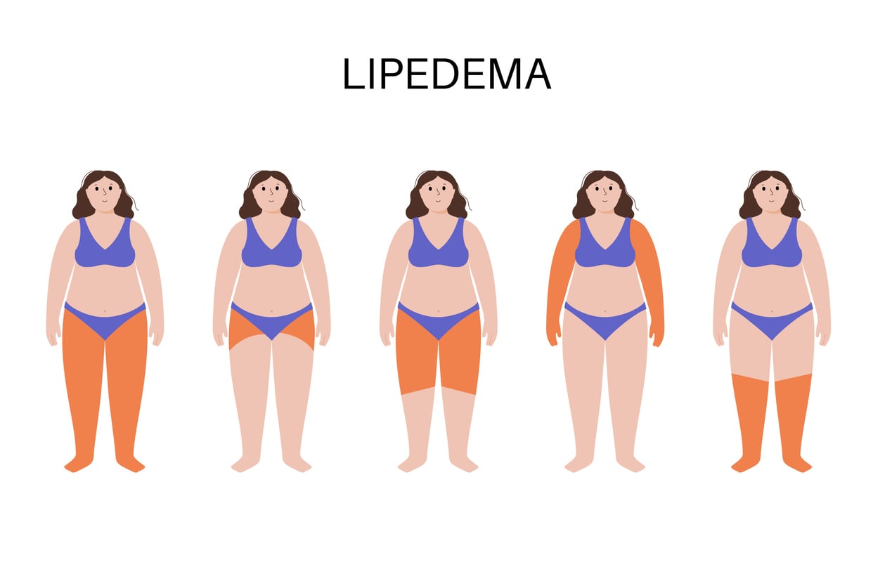 Maximizing Lipedema Results: How Exilis® and Sofwave™ Enhance Tumescent Liposuction