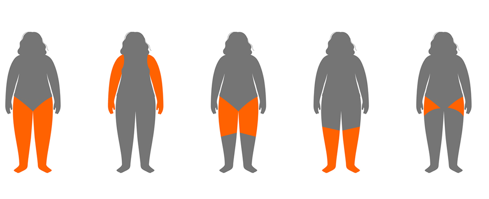 Why Diet and Exercise Alone Can’t Cure Lipedema