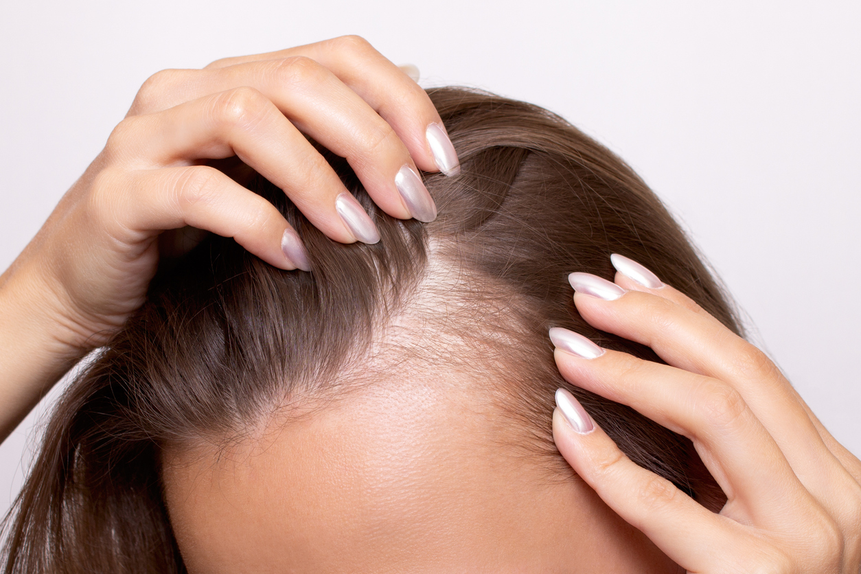 Women with thinning fair needing hair regrowth treatment