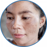 Melasma 200 (1) woman-with-melasma-on-cheeks
