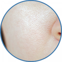 enlarged-pores-200 enlarged-pores-on-womans-face