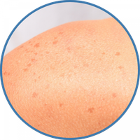 pigmentation-sun-spots-200 pigmentation-issues-from-sun-damage-on-shoulders