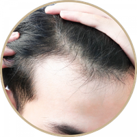thin-hair-Androgenetic-Alopecia man-with-Androgenetic Alopecia