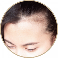 woman-with-thinning-hair woman-with-thinning-hair