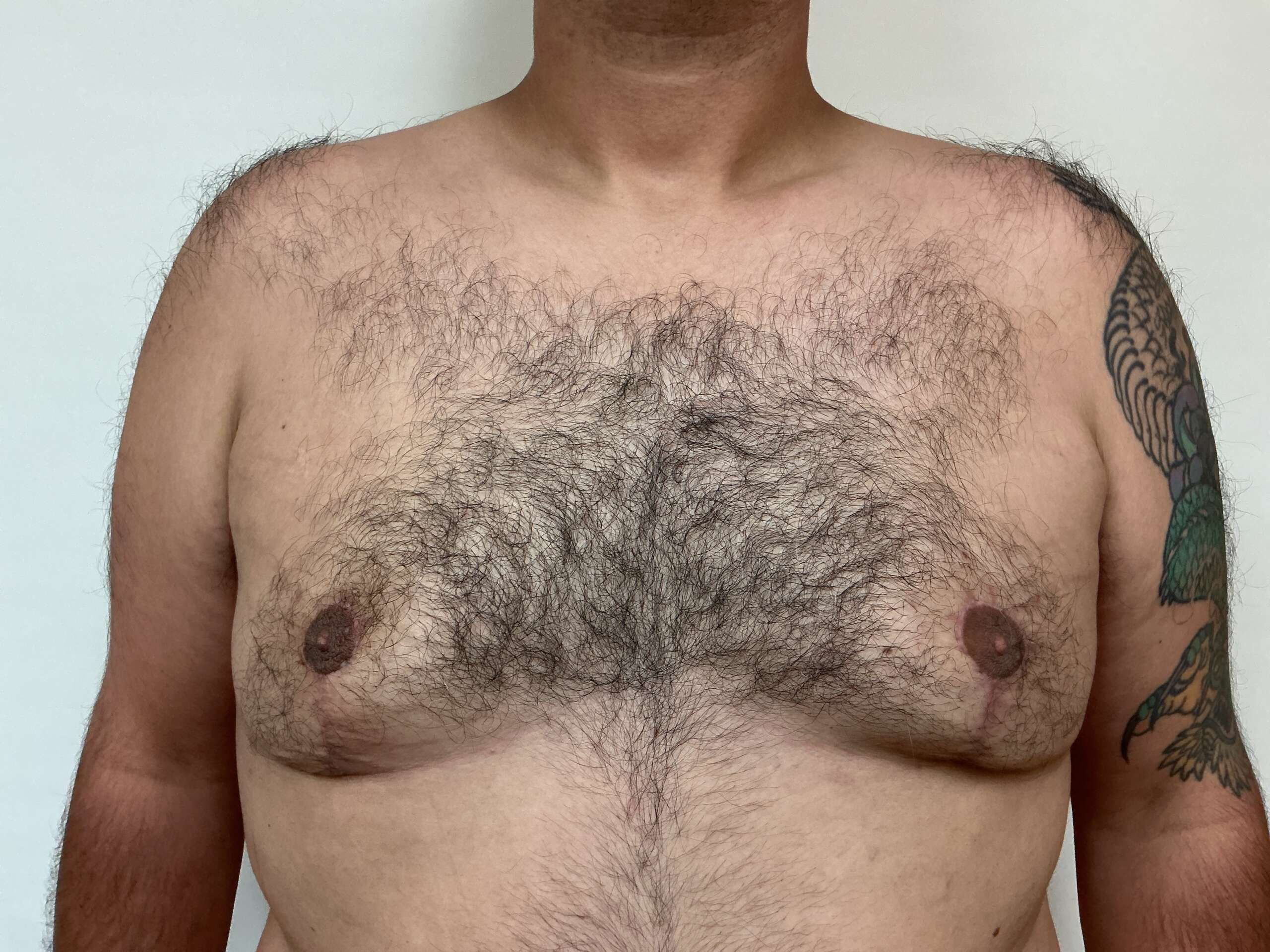 After Gynecomastia (Front View) 
