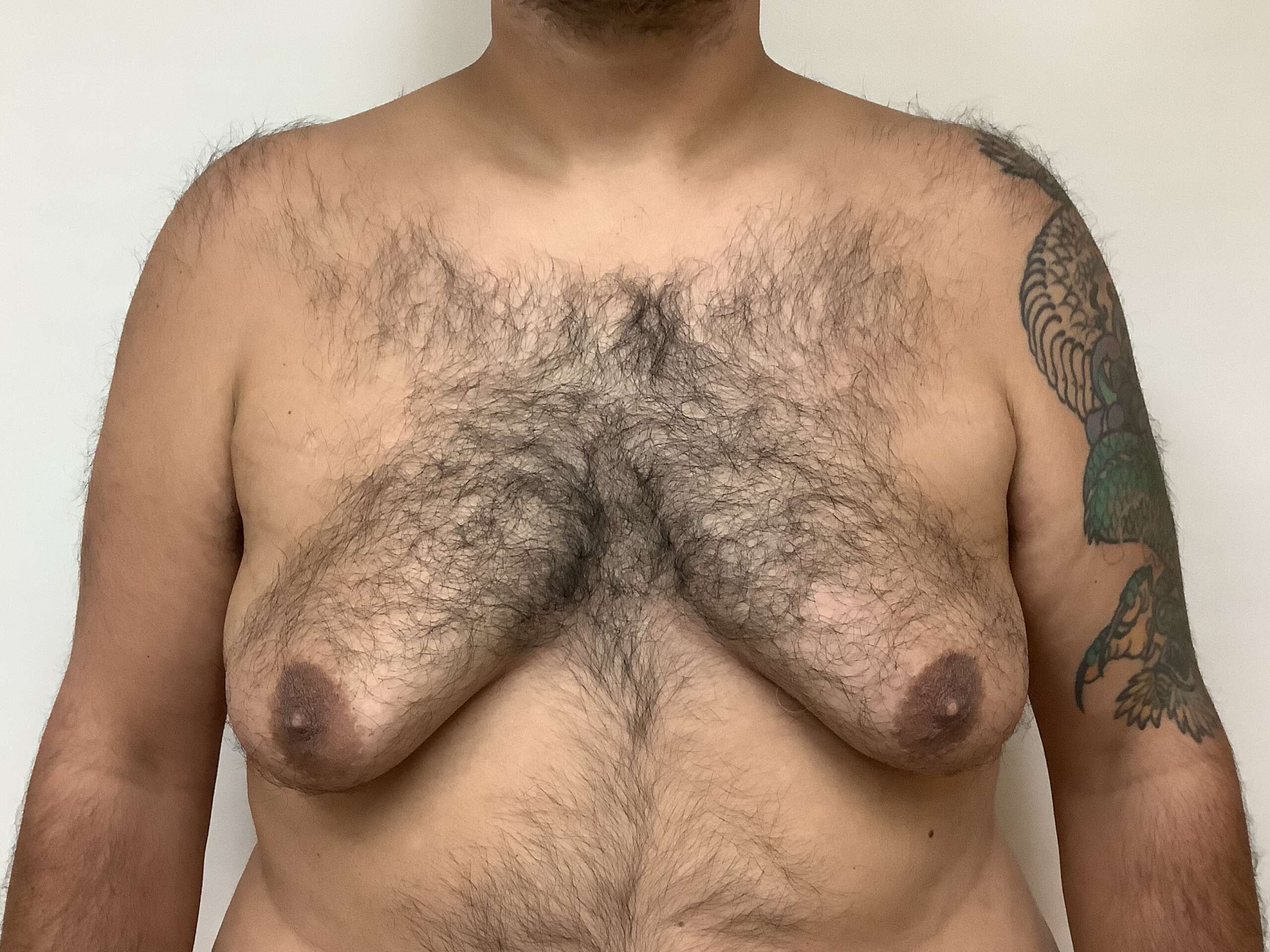 Before Gynecomastia (Front View) 