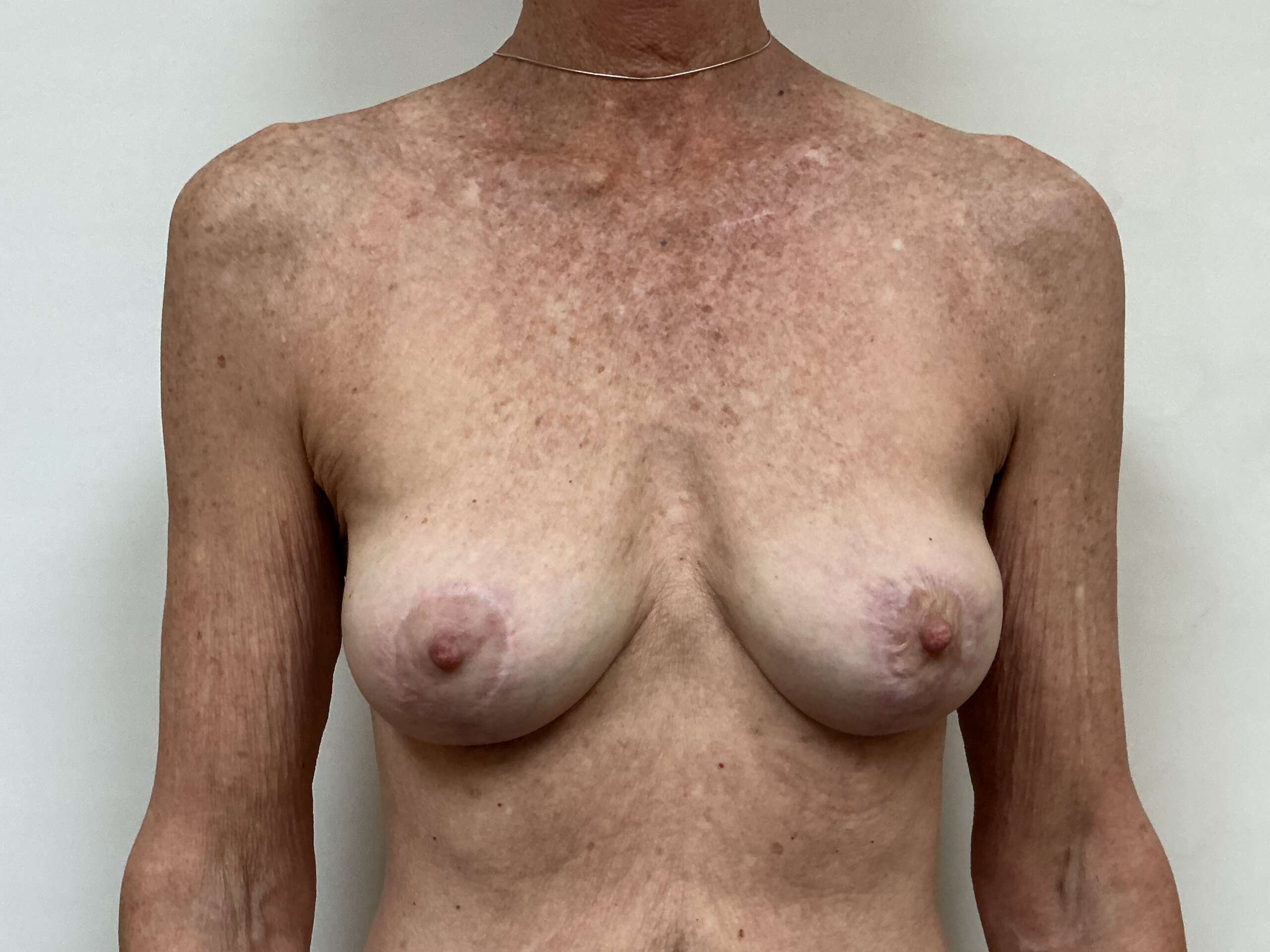 Front View Before Explant & Breast Reduction Procedure