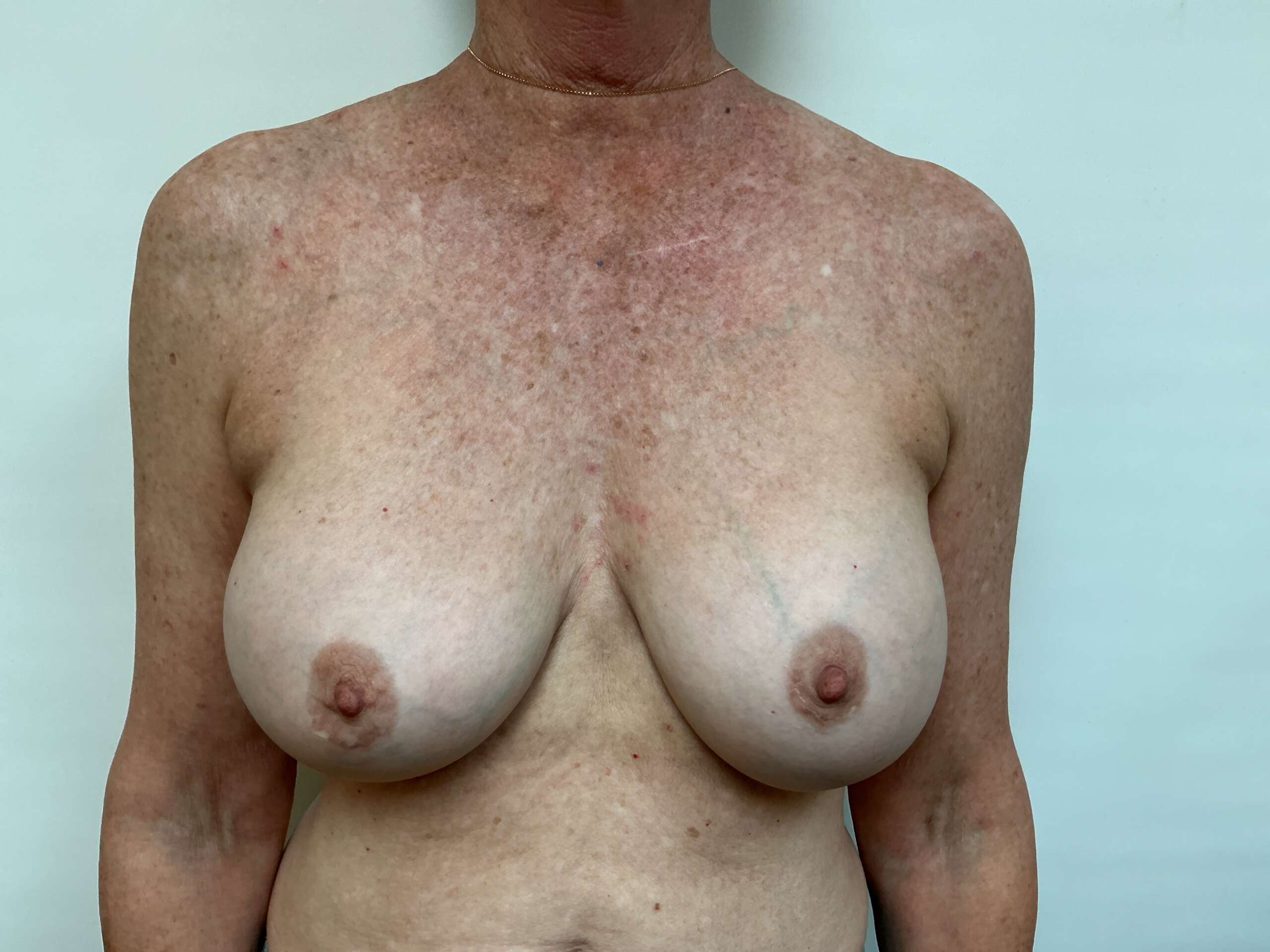 Front View Before Explant & Breast Reduction Procedure