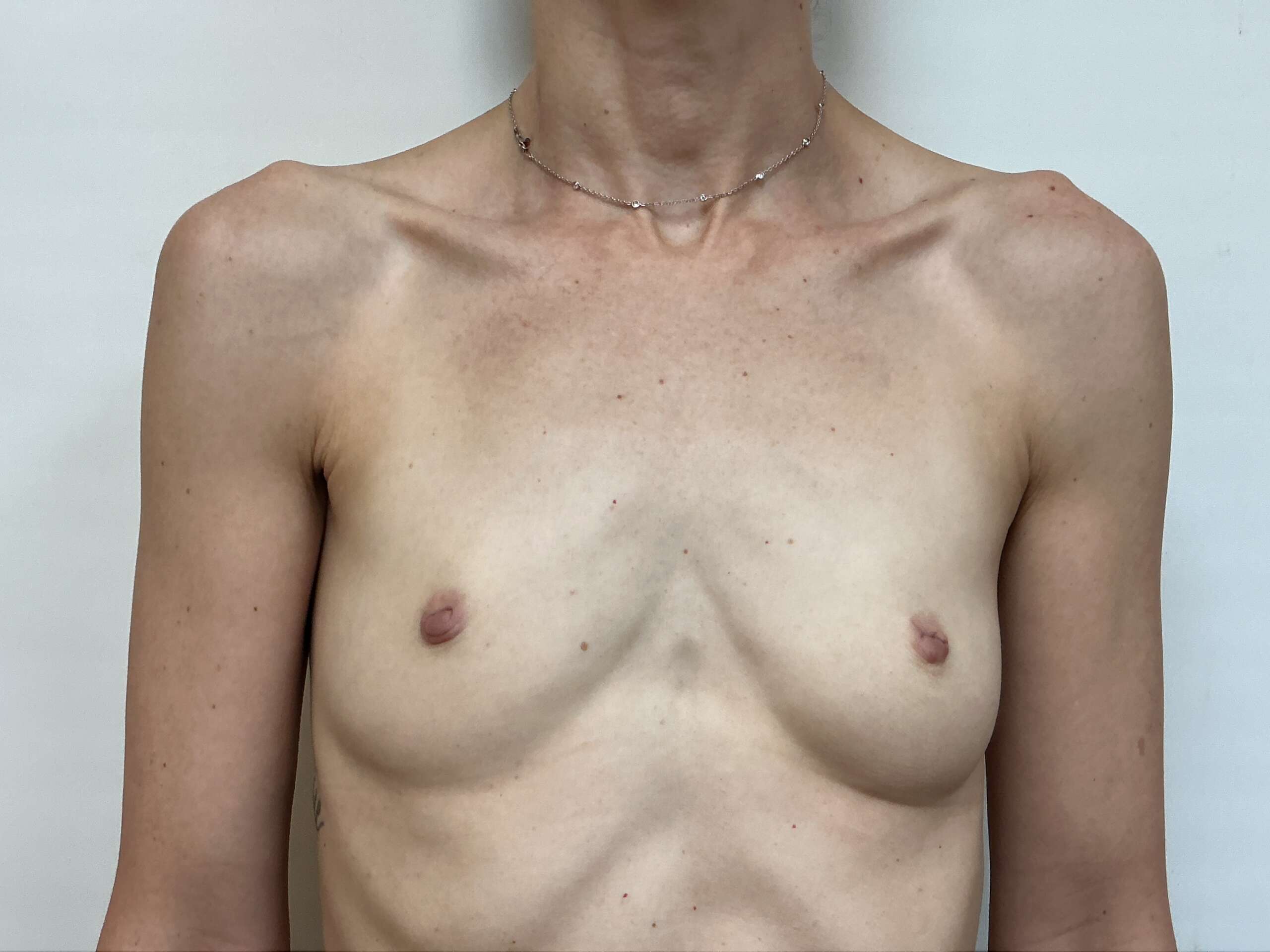 Before Breast Augmentation Surgery Front View