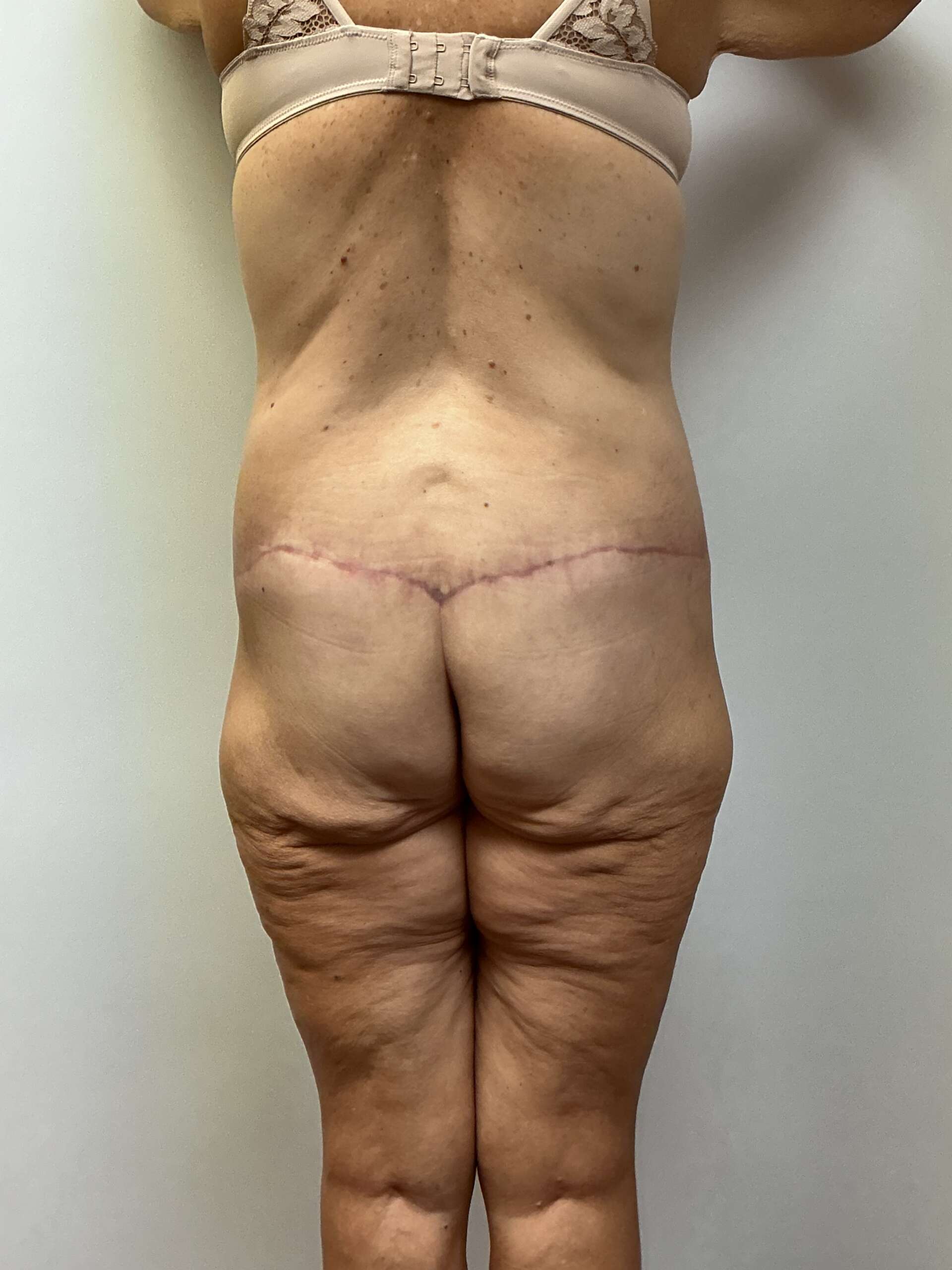 Back View After Total Lower Body Lift