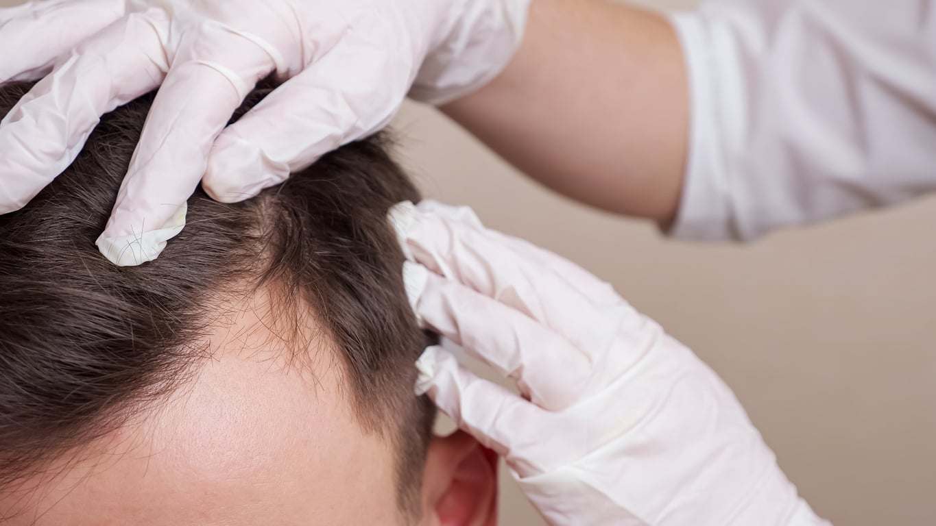Hair consultation for PRP